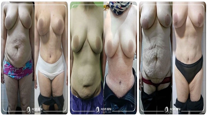 صور قبل وبعد عمليات نحت الجسم في إيران